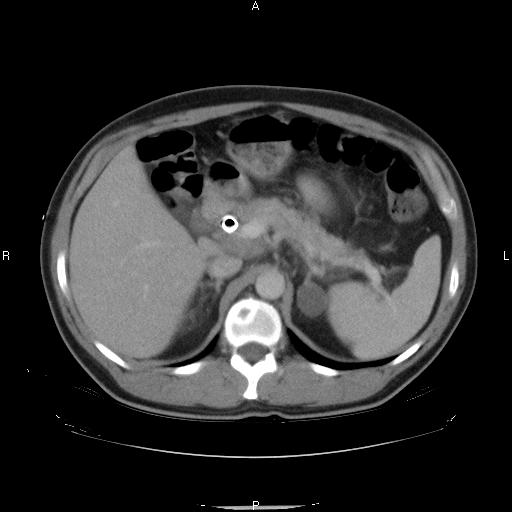 Bone Tumours